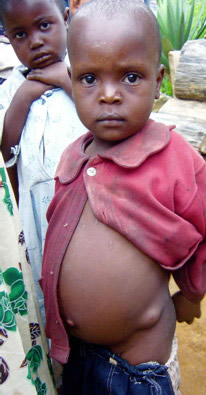 Young child with hip nodule