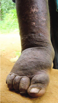 The effects of lymphatic filariasis